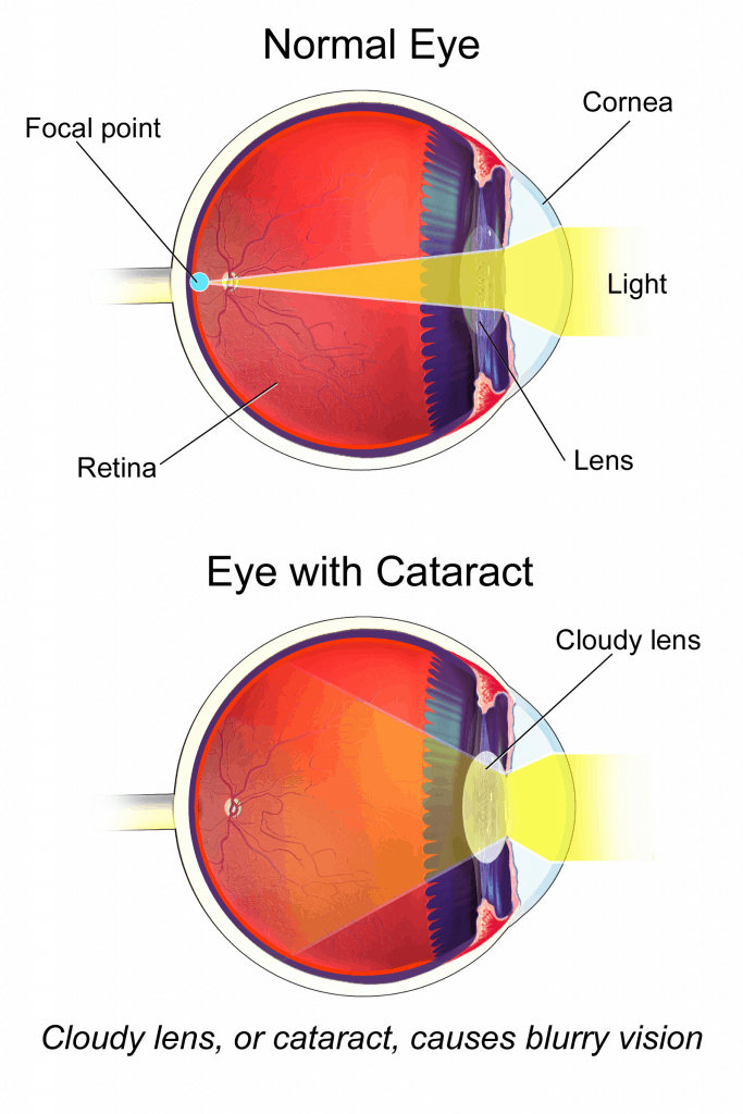 Cataracts-683×1024