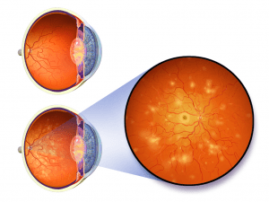 Diabetic-Retinopathy-300×225