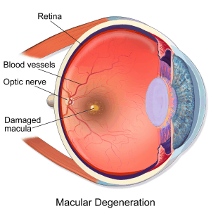 Macular_Degeneration-300×300