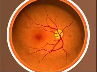 age-related-macular-degeneration